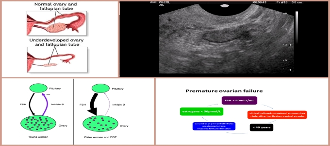 premature_ovarian_failure