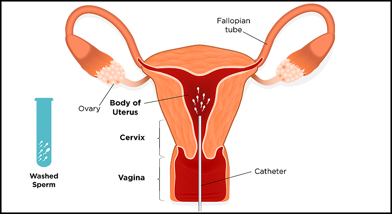 Ivf Iui